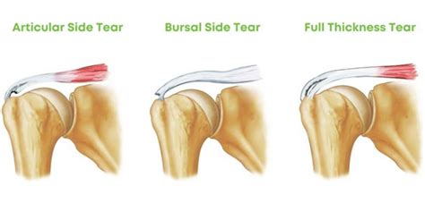 shoulder supraspinatus tear test|incomplete full thickness tear supraspinatus.